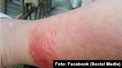 Secuelas del chikungunya