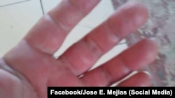 Las secuelas de los virus en Cuba: testimonios